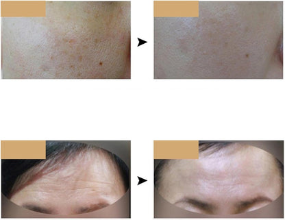 GlowMask™- Mascarilla LED rejuvenecedora